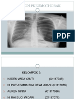 Tension Pneumothorak