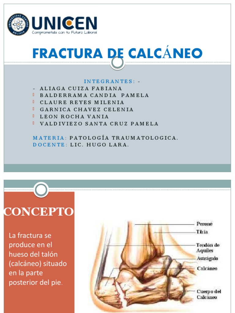 Fractura Del Calcaneo | PDF | Tecnología