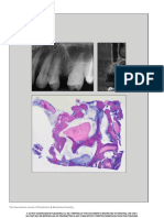 New Bone Formation Using An Extracted Tooth