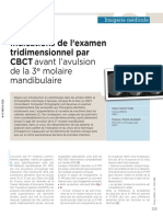 Indications de L'examen Tridimensionnel Par CBCT Avant L'avulsion de La 3e Molaire Mandibulaire