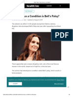 Bell's Palsy - How Serious A Condition