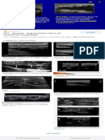 Bursitis Suprarotuliana Ecografia - Búsqueda de Google