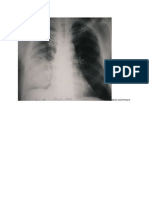 abces pulmonary