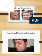 Xeroderma Pigmentoso Powerpoint