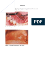 Eritroplakia Mulut
