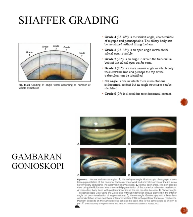 Shaffer Grading of Gonioscopy Angles | PDF