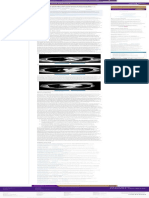 Delayed Silicone Breast Implant Infection With Mycobacterium Avium-Intracellulare - Aesthetic Surger - En.es