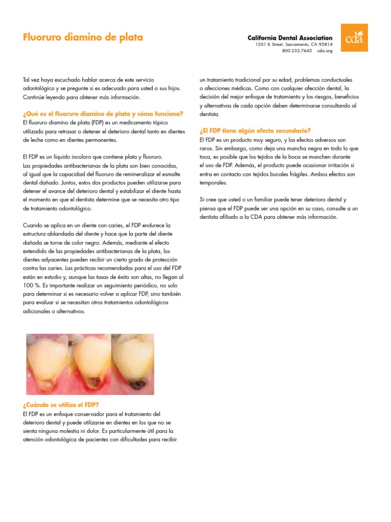 Silver Diamine Fluoride Spanish PDF Odontología Diente