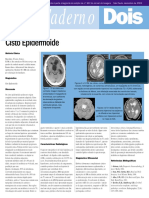 Cisto Epidermoide