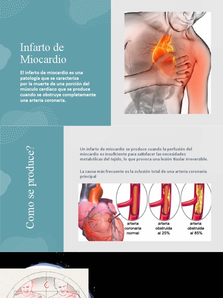 Infarto de Miocardio (IAM) | PDF | Infarto de miocardio | Medicina CLINICA