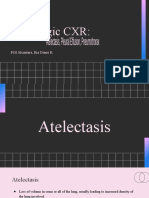 Signs of Atelectasis and Pneumothorax on CXR