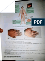 Anemia 2 and Malaria 1