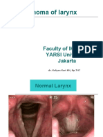 Carcinoma of Larynx: Faculty of Medicine YARSI University Jakarta