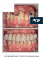 martens2014 peri implant outcome of immediately loaded implant