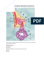 Carcinoma Ductal Inductivo