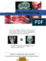 Fractura Panfacial