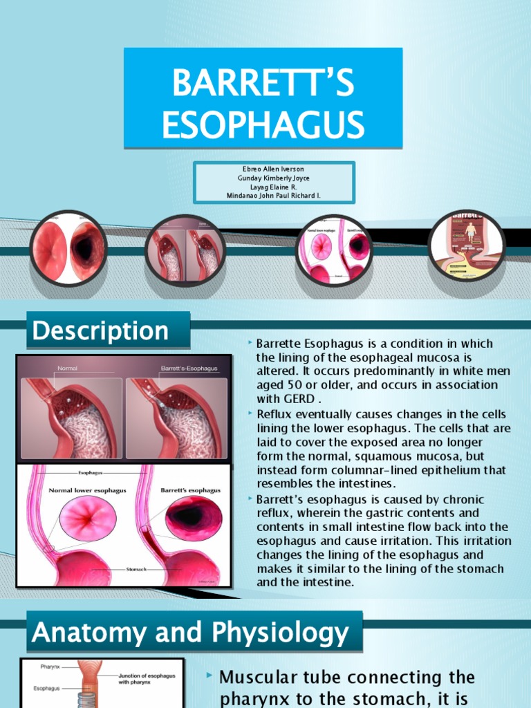 Understanding Barrett's Esophagus Causes, Risk Factors, Diagnosis