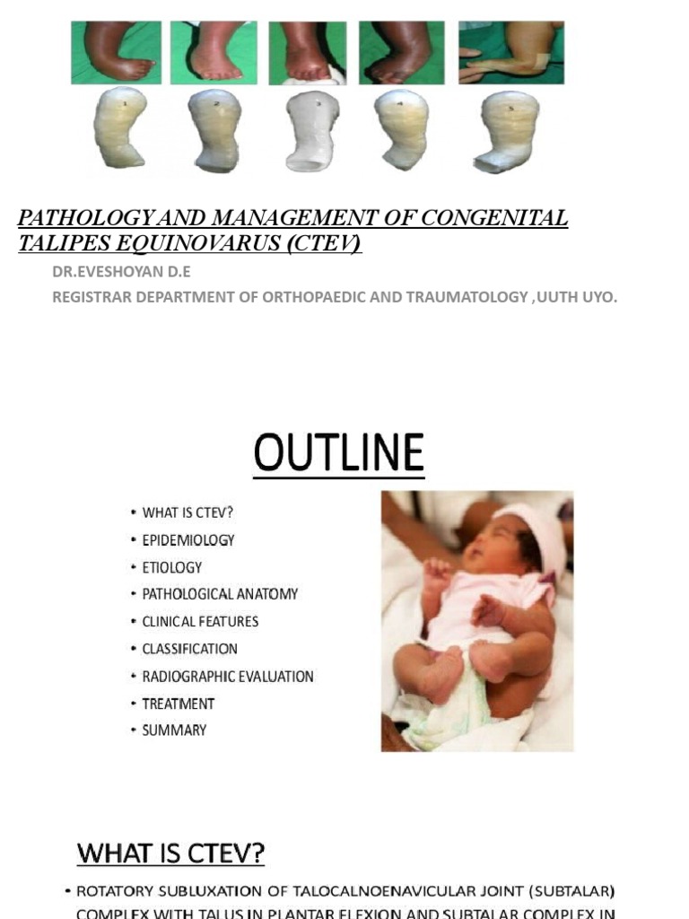 Pathology and Management of Congenital Talipes Equinovarus (Ctev