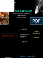 Quiste Radicular-Gabriela Lugo Huerta