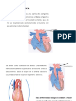 Coartacion Aortica