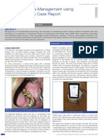 Oral Leukoplakia Management Using Diode Laser A Case Report (Chaudri DKK, 2019)