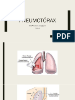 PNEUMOTÓRAX: DEFINIÇÃO, CLASSIFICAÇÃO E TRATAMENTO