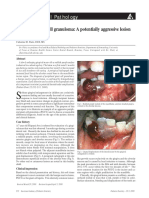 Peripheral Giant Cell Granuloma: A Potentially Aggressive Lesion in Children