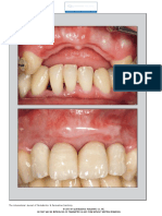 Vertical Ridge Aurmentation