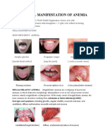 Oral Manifestation of Anemia 1