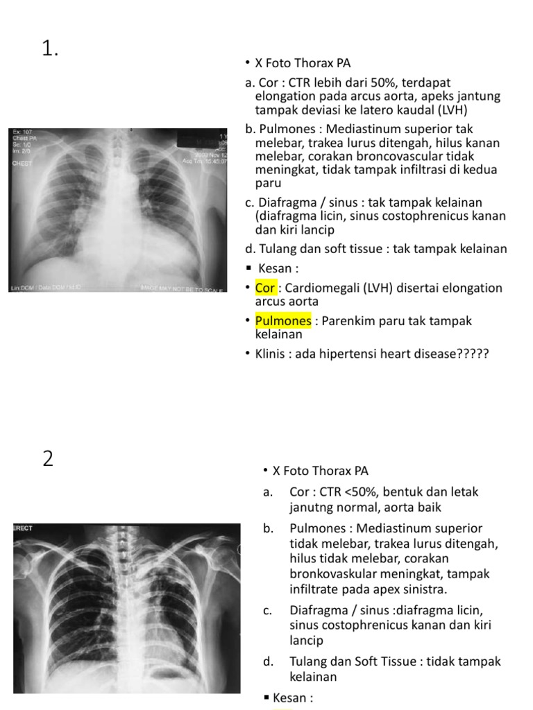 Analisis Rontgen Thorax dan Diafragma | PDF