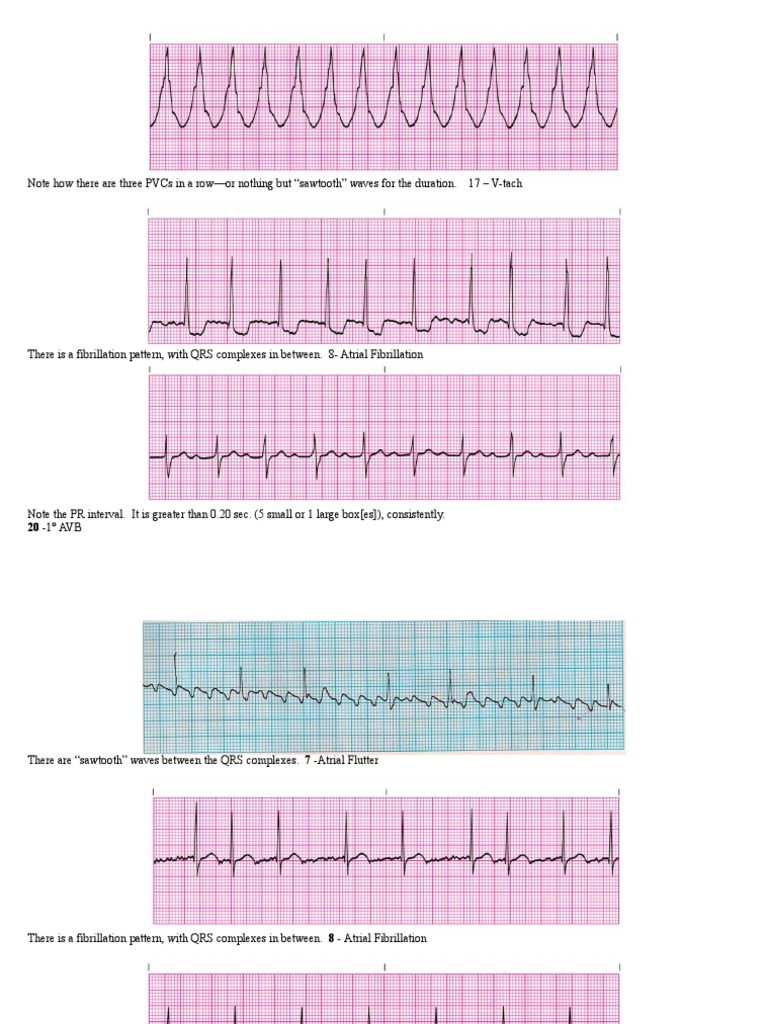 Free Printable Ekg Practice Strips For Pct