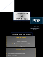 gonarthrose-et-IRM3T