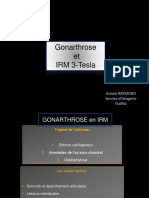 Gonarthrose Et IRM3T