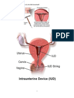 The 5 Kinds of IUD Birth Control and Their Side Effects