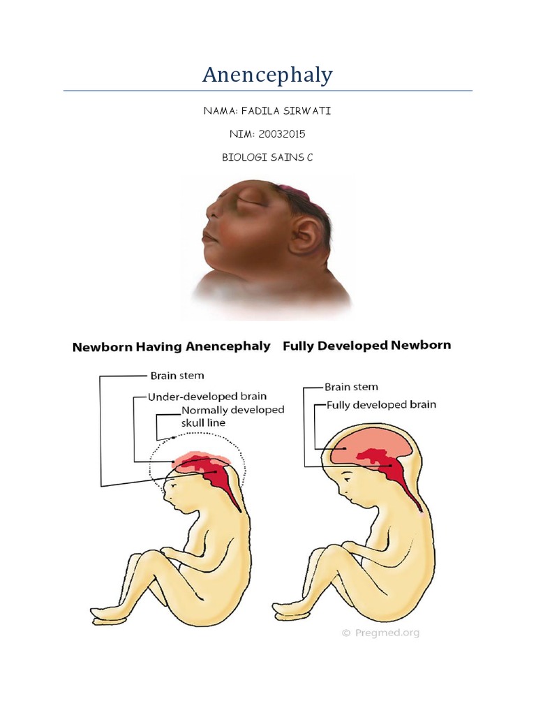 Anencephaly: Penyebab dan Pencegahan | PDF
