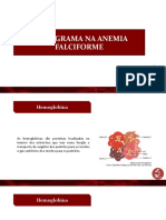 Anemia Falciforme