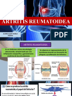 ARTRITIS REUMATOIDEA