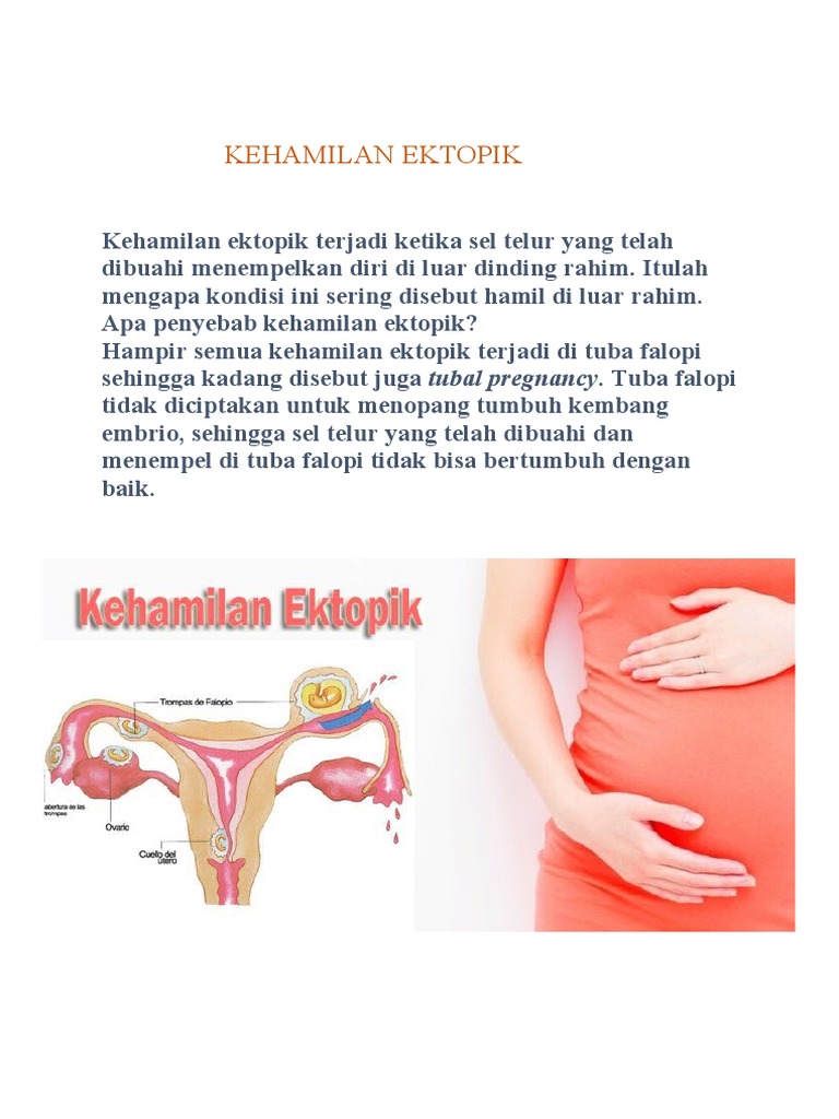 Kehamilan Ektopik | PDF