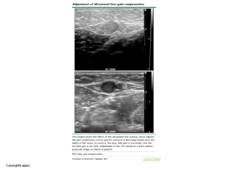 Adjustment of Ultrasound Time Gain Compensation PDF