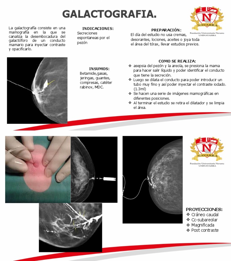 Galactografia PDF