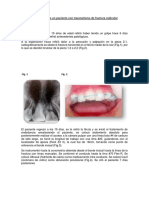 Caso Clínico de Un Paciente Con Traumatismo de Fractura Radicular