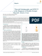 Contribution of Thyroid Scintigraphy and SPECT/ CT Imaging in the Diagnosis of Double Ectopic  Thyroid