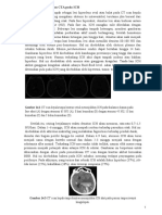 Swirl Sign, Dan Menandakan Perdarahan Aktif Masih Berlangsung. Setelah Hematoma