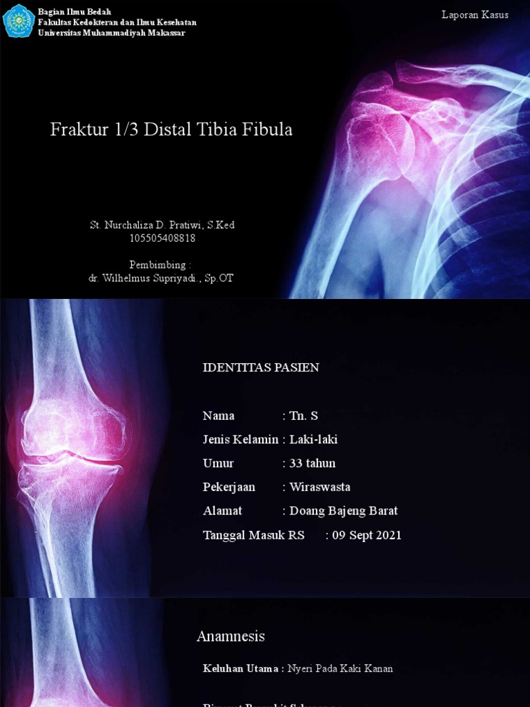 Laporan Kasus Fraktur 1,3 Distal Tibia Fibula - Ica | PDF