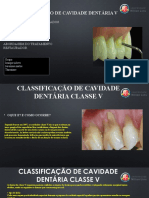 Classificação de Cavidade Dentária Classe V