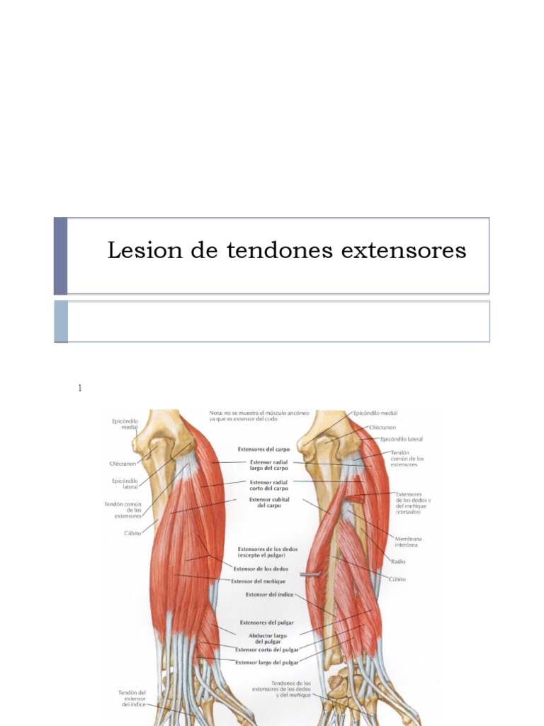 Lesion de tendones extensores de la mano