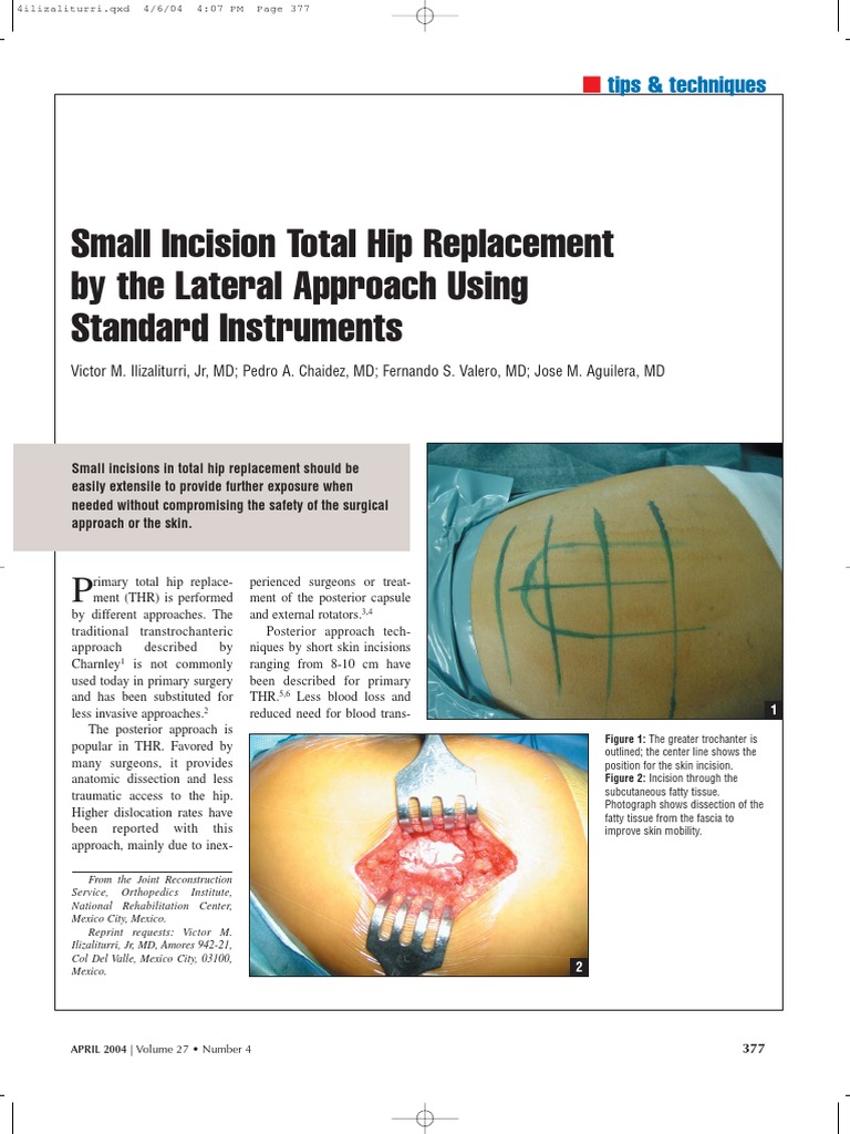 Small Incision Lateral Hip Replacement | PDF | Hip | Musculoskeletal System