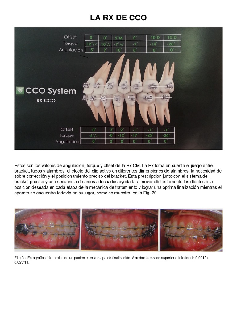 Corrección de rotaciones dentarias con Arco Recto: componentes