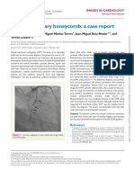 An Intracoronary Honeycomb: A Case Report