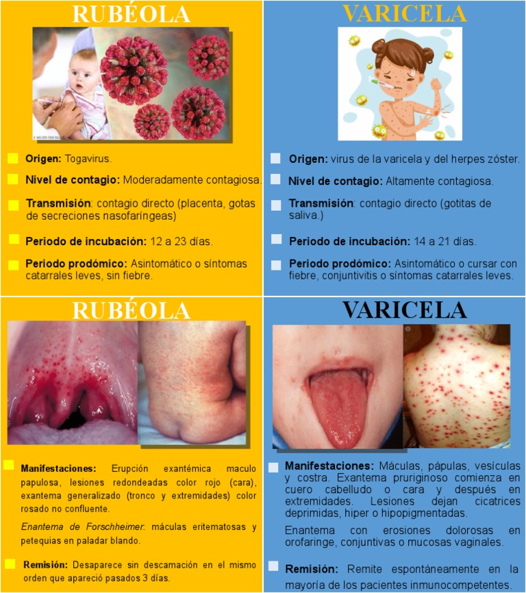 Conoce La Diferencia Entre Varicela, Rubéola, Sarampión Y Viruela – KAVGJN